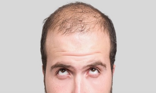 ریزش موی آقایان _ کلینیک